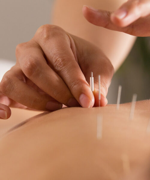 Acupuncture