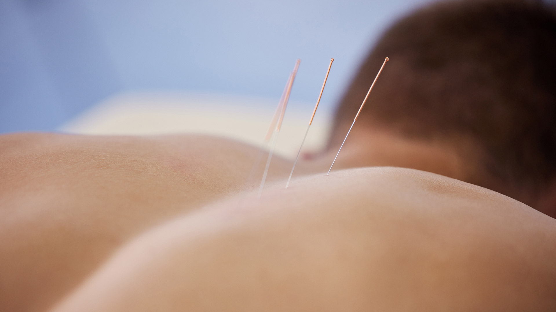 IMS/Dry Needling