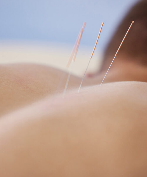 IMS/Dry Needling
